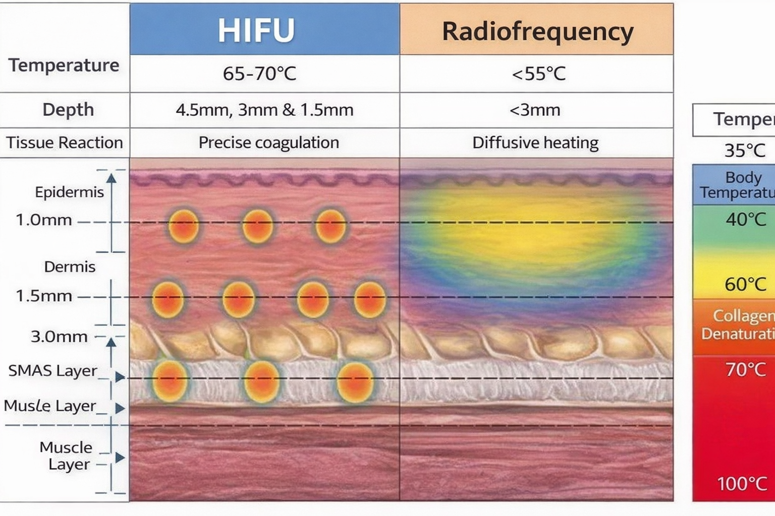 Ultherapy ultrasound vs Thermage radiofrequency treatment parameters and effectiveness
